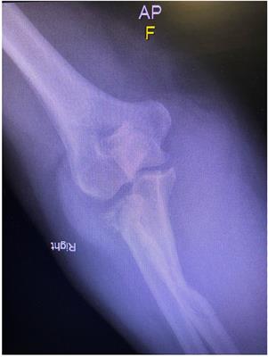 Olecranon With Concomitant Radial Head Fracture: A Case Series of Fifteen Patients